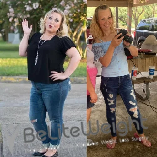 Weight Loss Surgery Before And After